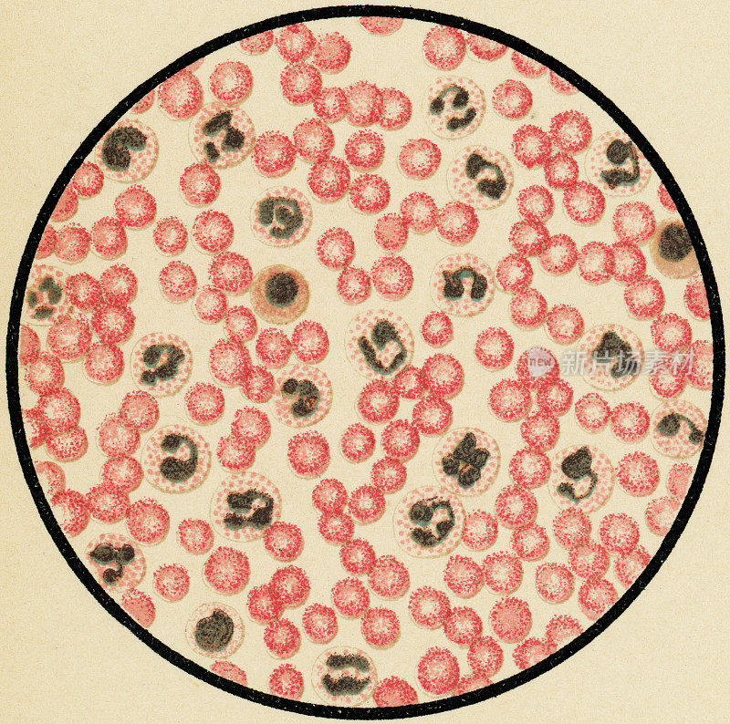 从肺炎患者的人体血细胞中白细胞增多的显微镜观察- 19世纪